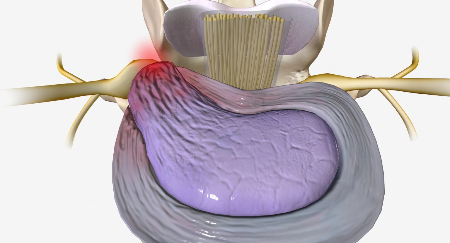 A,Herniated,Disc,Is,A,Condition,Characterized,By,Structural,Changes A,Herniated,Disc,Is,A,Condition,Characterized,By,Structural,Changes