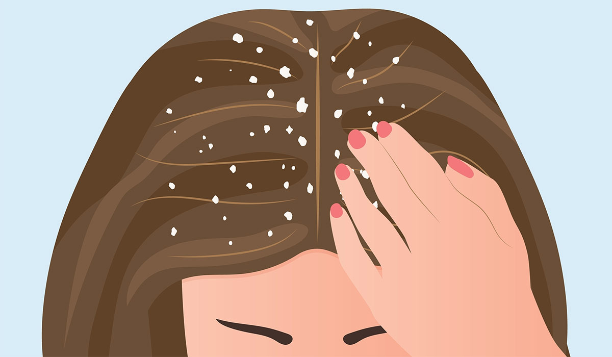 Dandruff