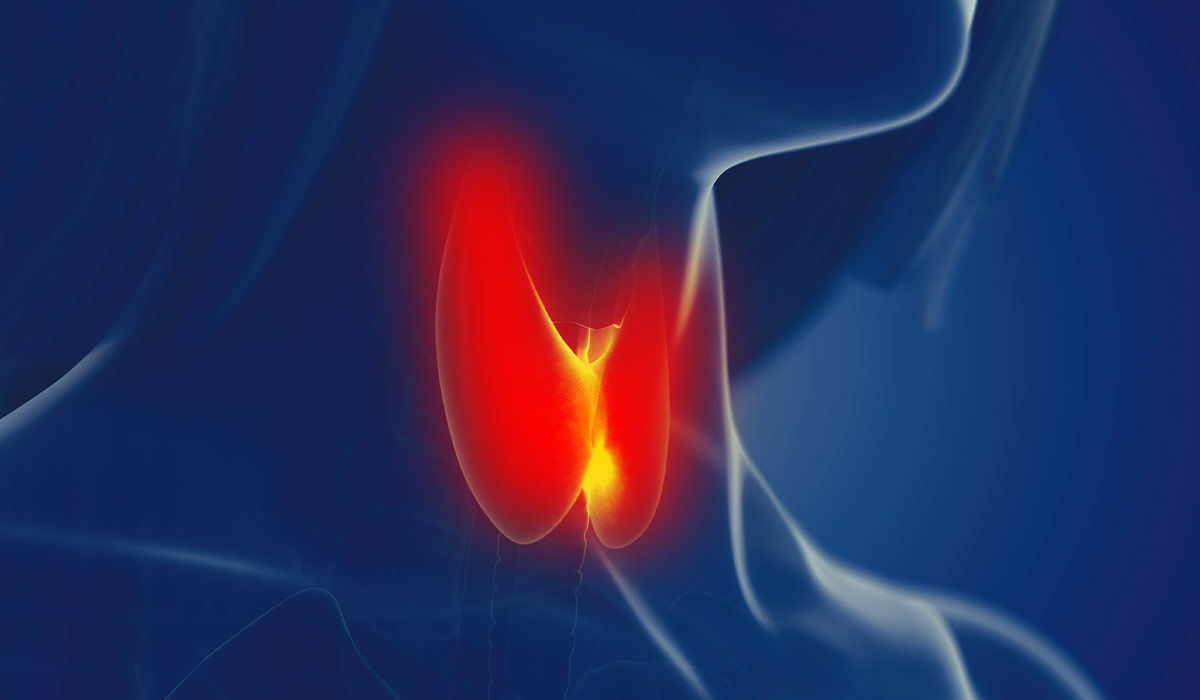 Goiter