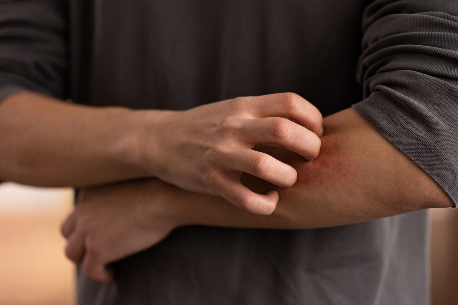 mosquito-bites-what-are-symptoms-treatment-amp-prevention-228848 mosquito-bites-what-are-symptoms-treatment-amp-prevention-228848