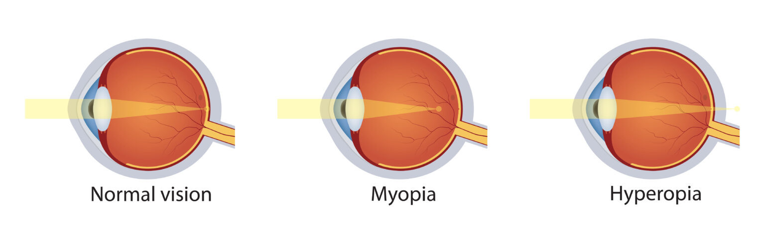 Normal,Vision,,Hyperopia,,Myopia.,Set,Of,Vision,Disorders.,Anatomy,Of Normal,Vision,,Hyperopia,,Myopia.,Set,Of,Vision,Disorders.,Anatomy,Of