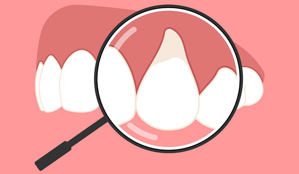 Periodontitis