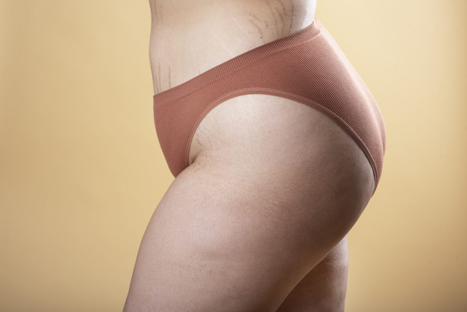 stretch-marks-what-are-causes-amp-prevention-696172 stretch-marks-what-are-causes-amp-prevention-696172