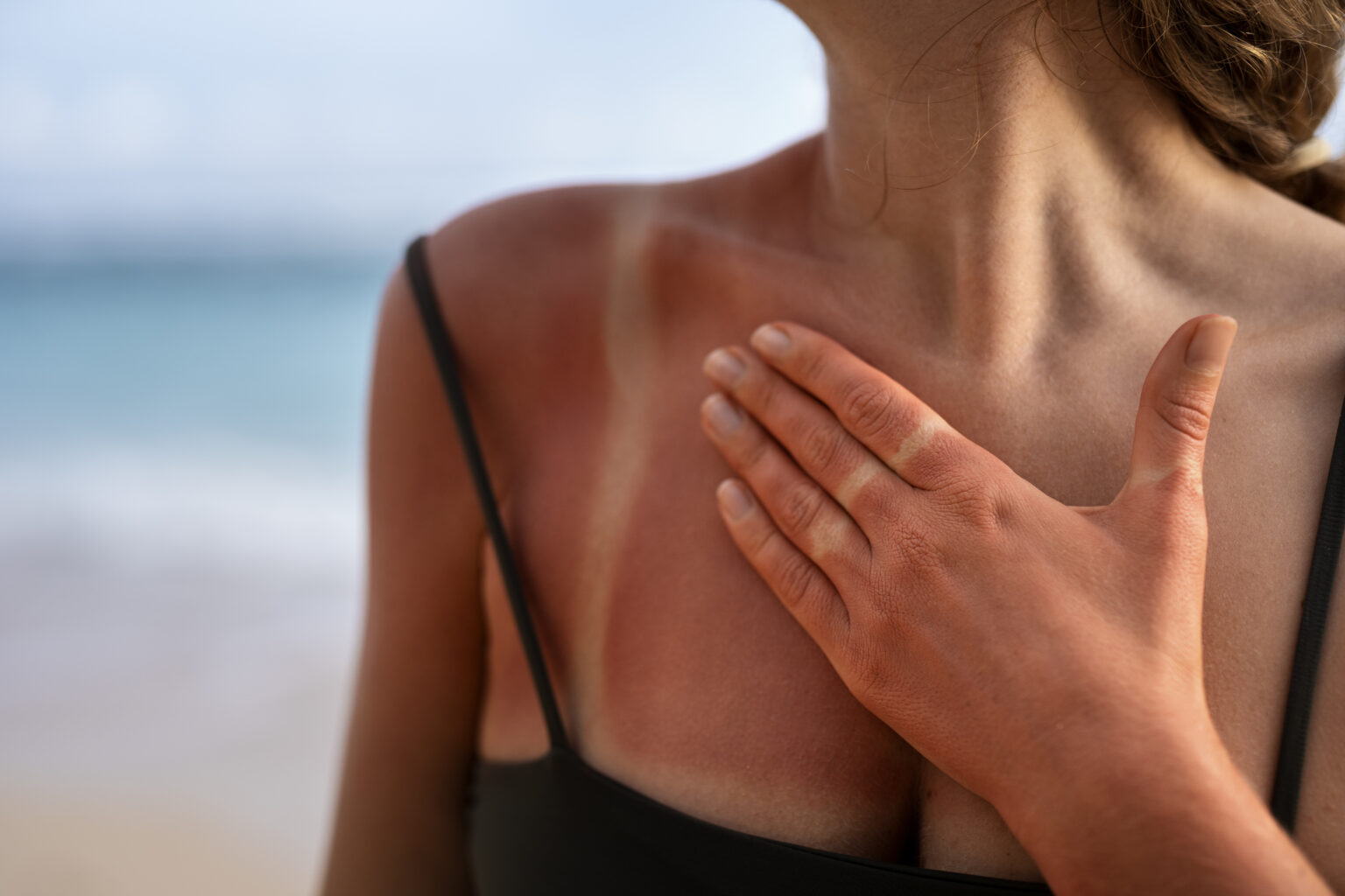 sunburn-what-is-symptoms-degrees-amp-first-aid-507740 sunburn-what-is-symptoms-degrees-amp-first-aid-507740