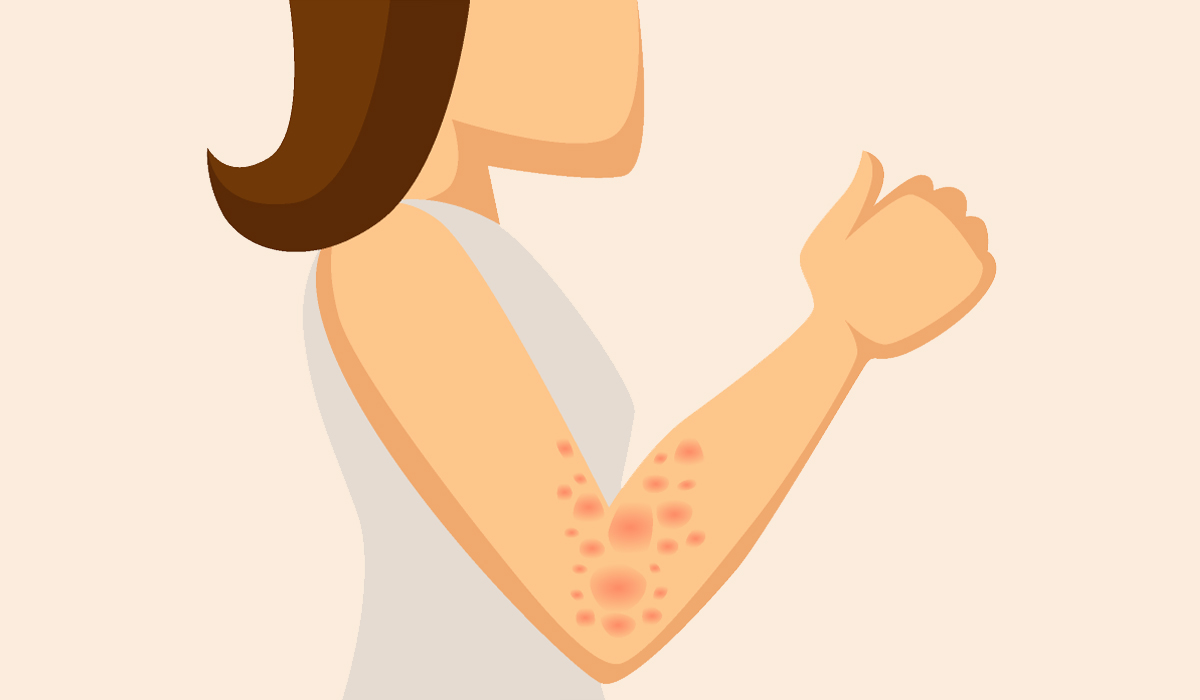 Angioedema
