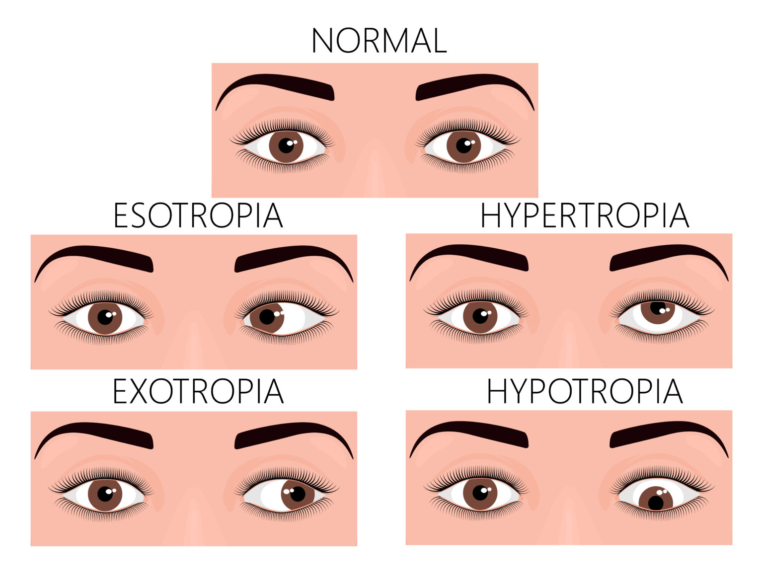 Vector,Illustration,Of,Normal,Human,Eyes,And,Eyes,With,Problem. Vector,Illustration,Of,Normal,Human,Eyes,And,Eyes,With,Problem.