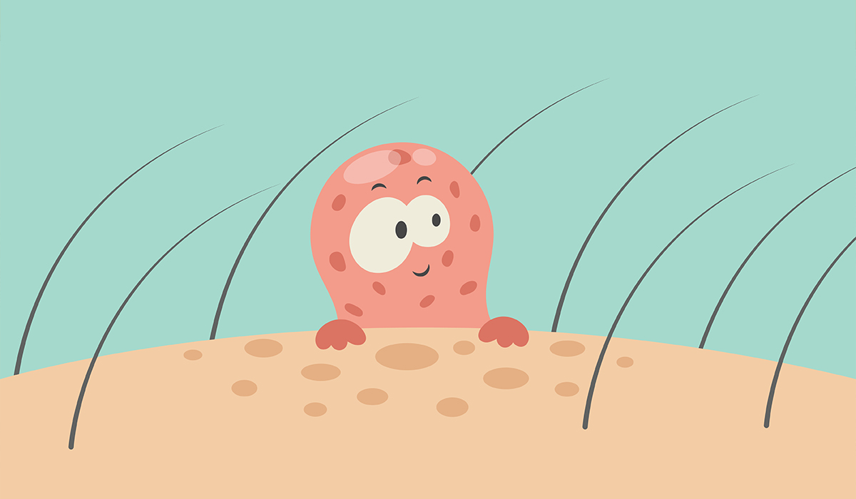 Warts