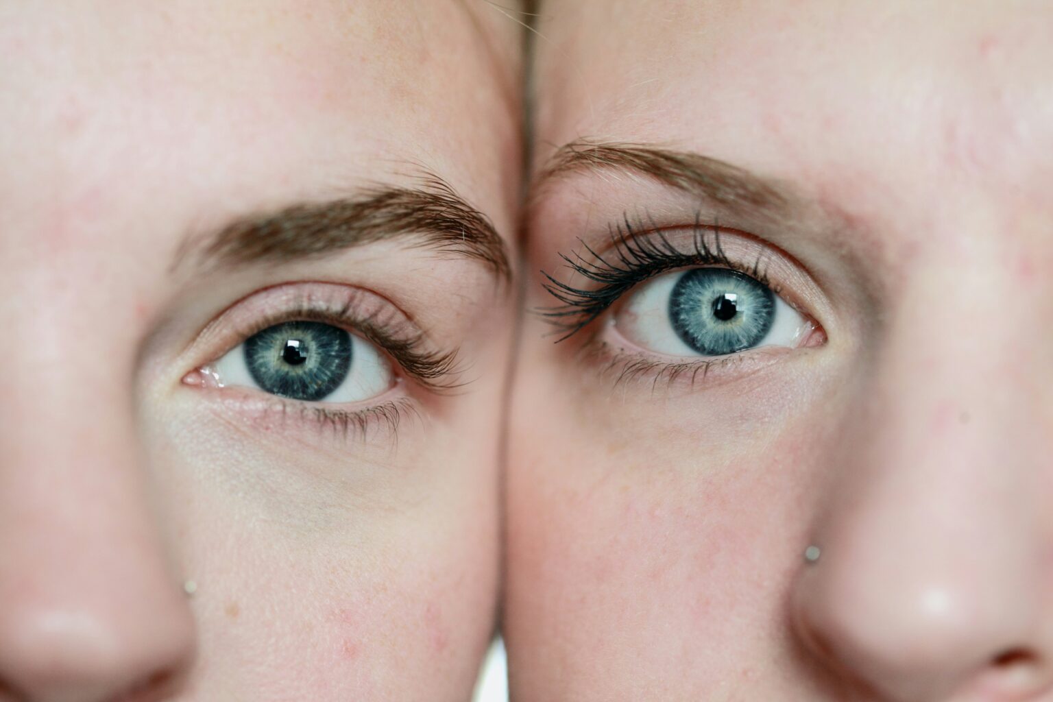 albinism-638493