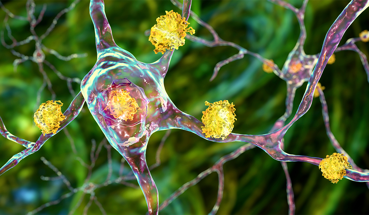 Huntington’s Disease