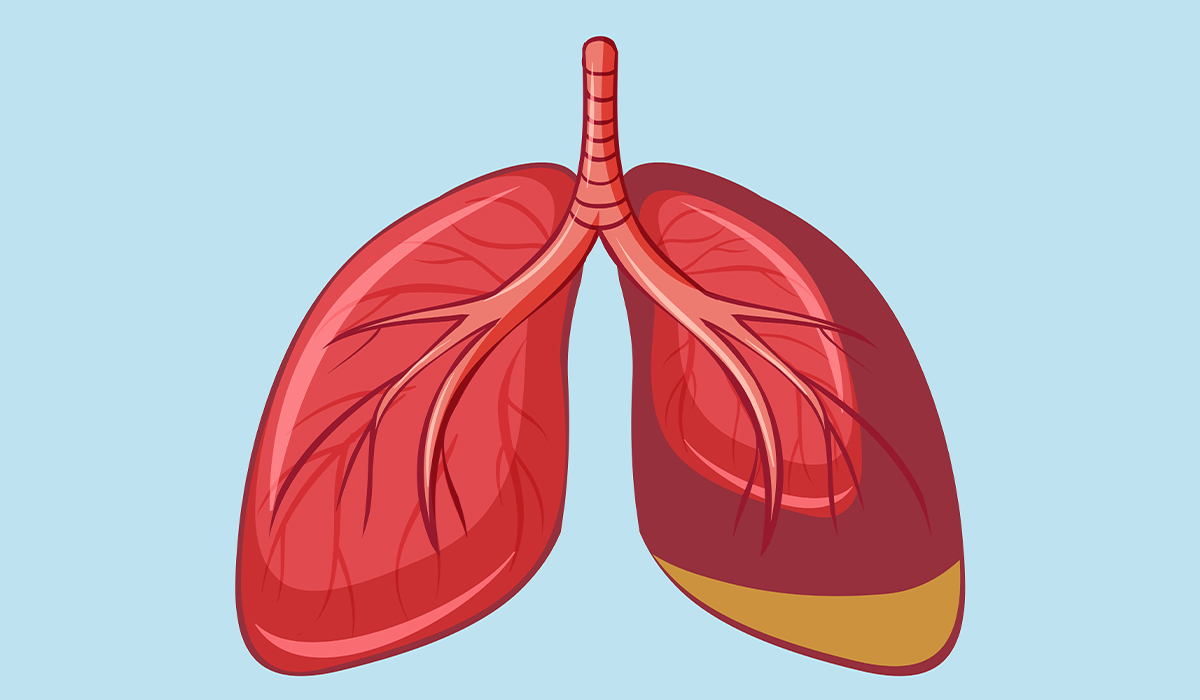 Mesothelioma