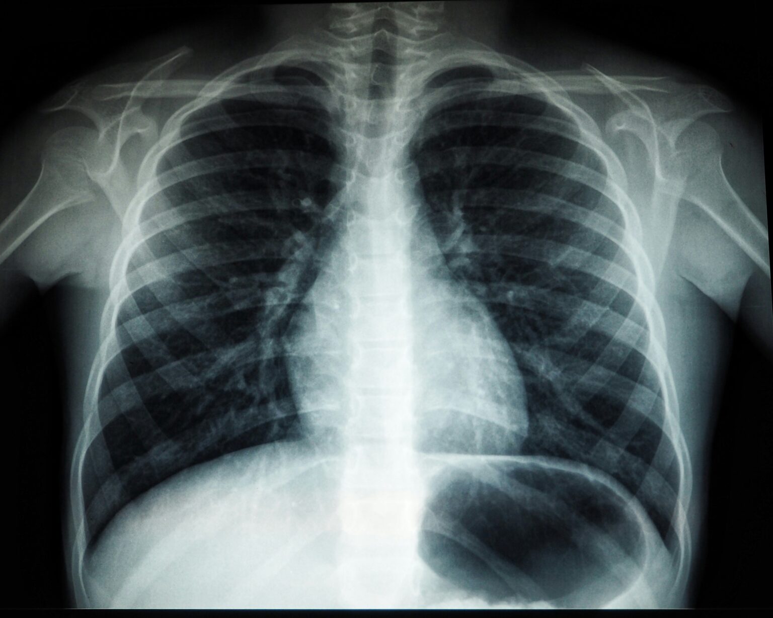 mesothelioma-what-is-types-causes-diagnosis-and-treatment-179138 mesothelioma-what-is-types-causes-diagnosis-and-treatment-179138