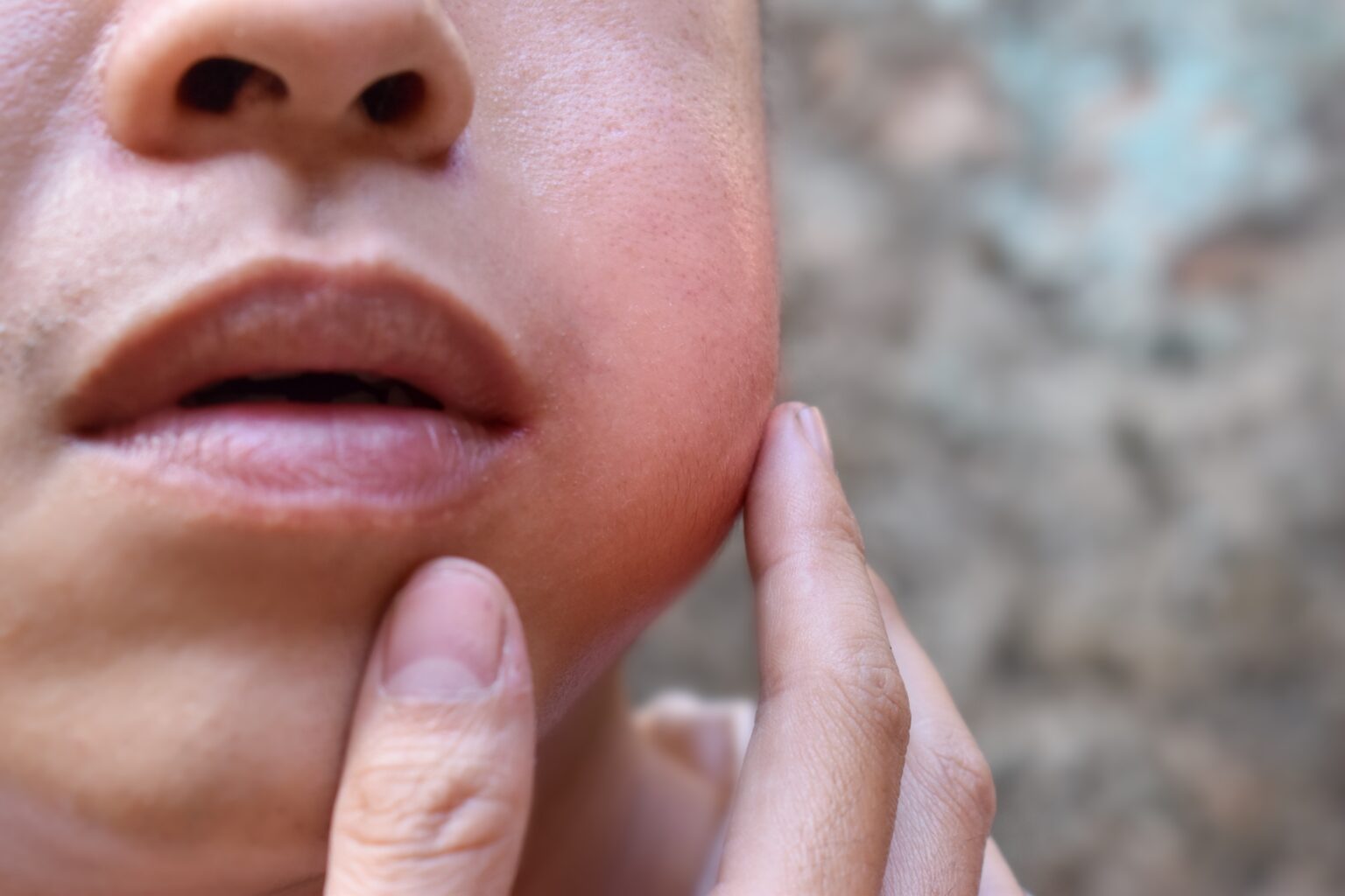 Swelling,At,The,Cheek,Of,Asian,Young,Man.,Inflammation,Of Swelling,At,The,Cheek,Of,Asian,Young,Man.,Inflammation,Of