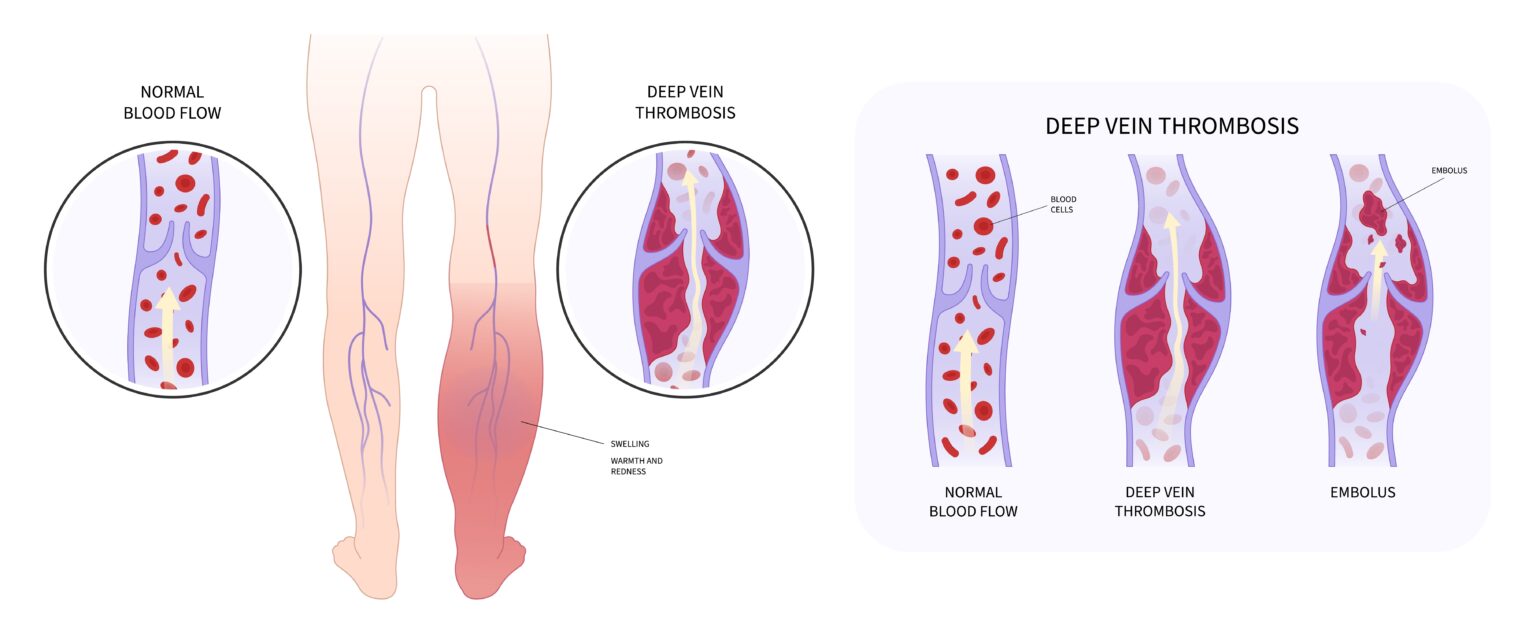 Varicose,Veins,Swelling,Chronic,Leg,Pain,Obesity,Ankle,Foot,Diabetes Varicose,Veins,Swelling,Chronic,Leg,Pain,Obesity,Ankle,Foot,Diabetes