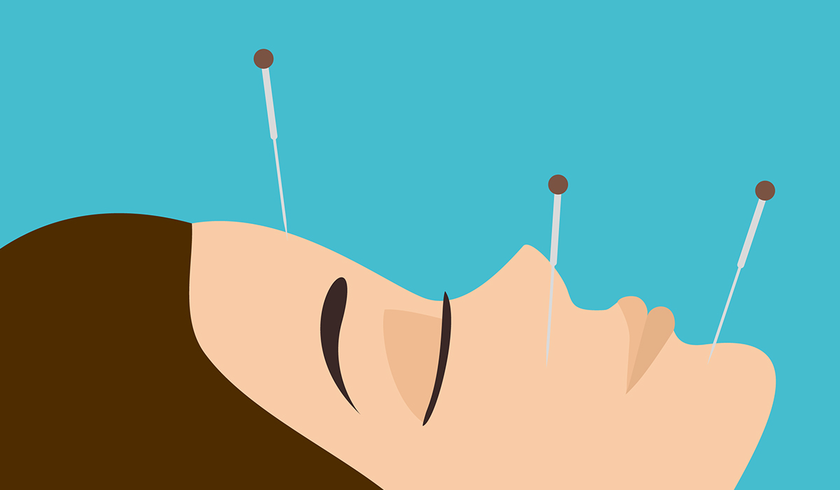 Acupuncture