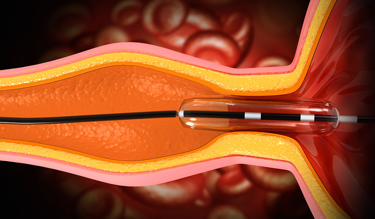 Angioplasty