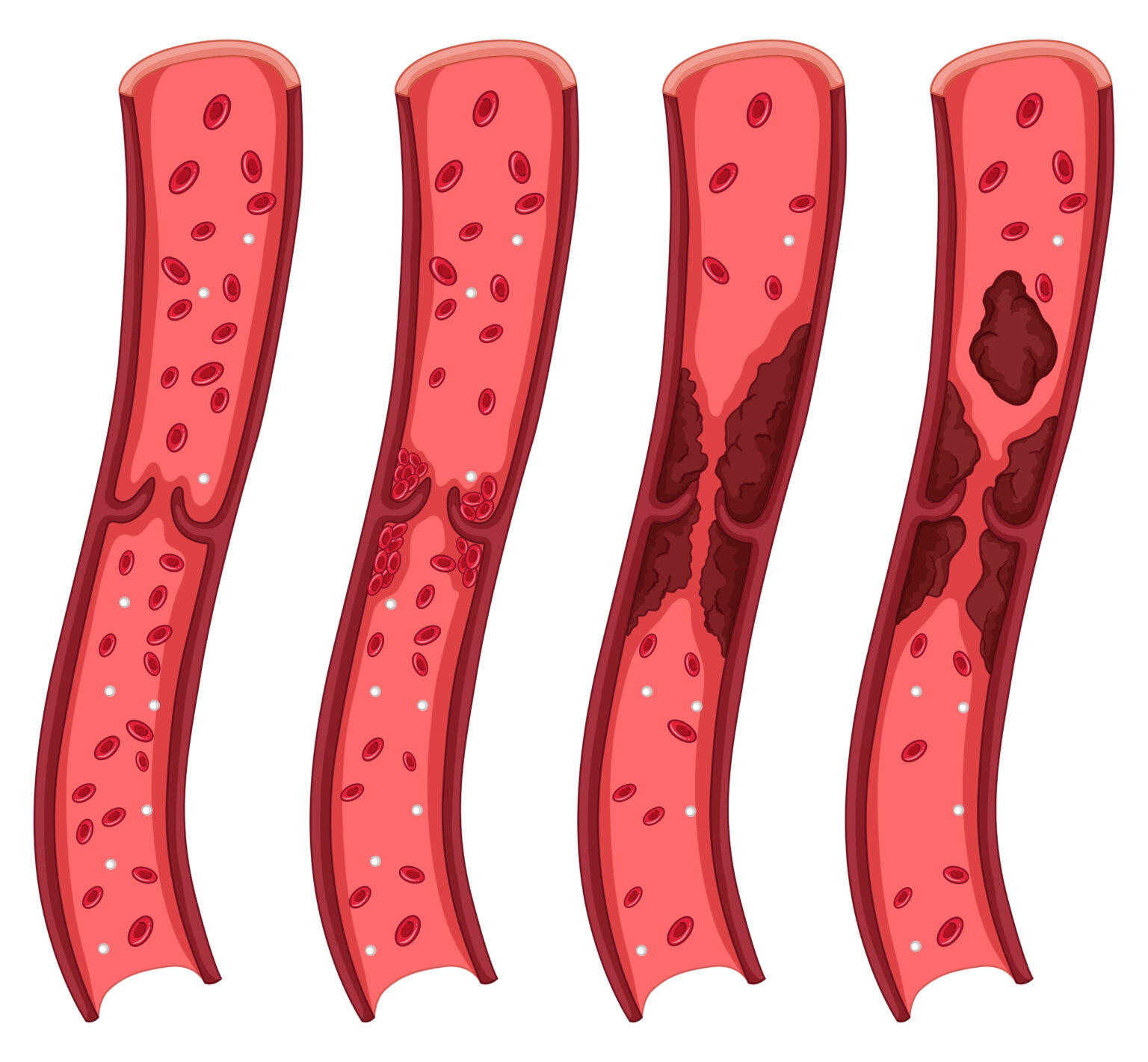 Blood clot diagram on white Blood clot diagram on white