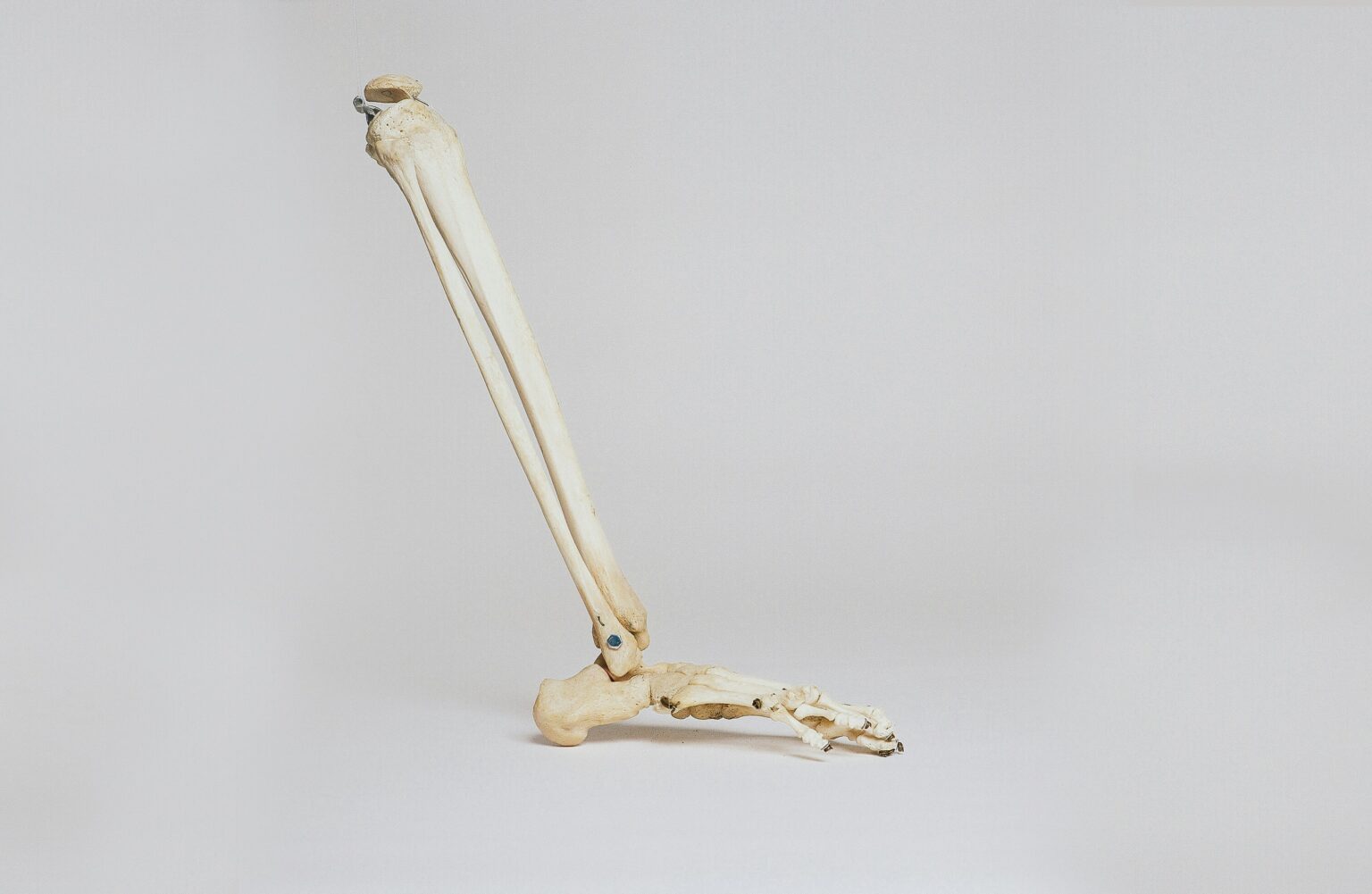 bone-fracture-what-is-causes-diagnosis-treatment-and-prognosis-852172 bone-fracture-what-is-causes-diagnosis-treatment-and-prognosis-852172