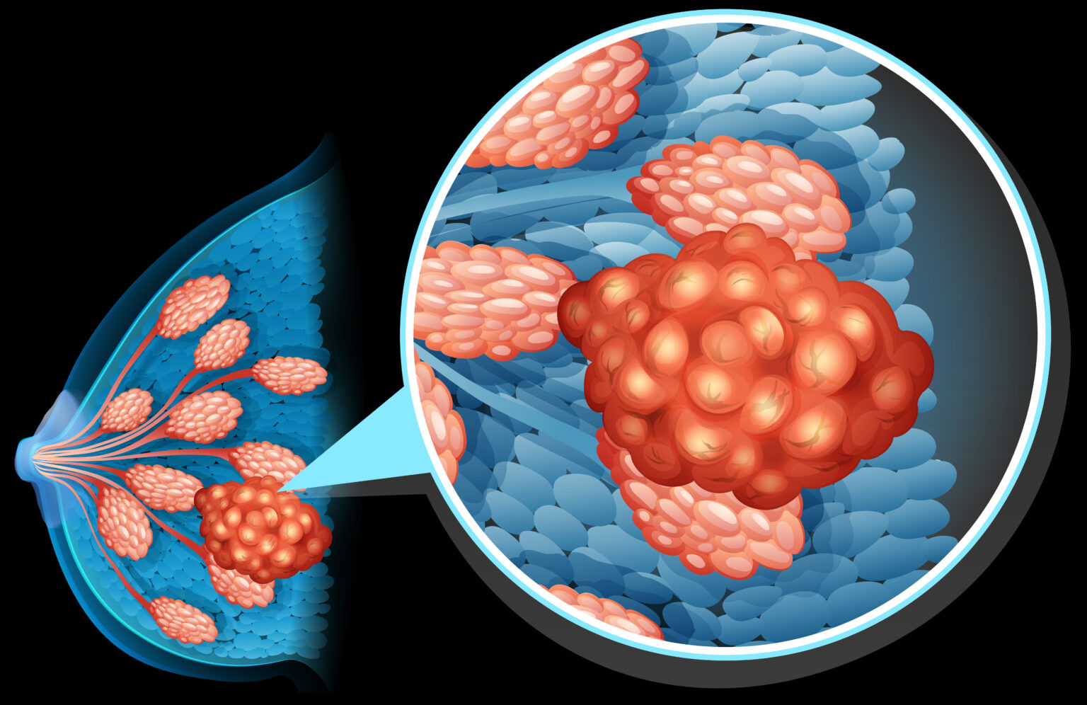 Breast,Cancer,Diagram,Close,Up,Illustration Breast,Cancer,Diagram,Close,Up,Illustration