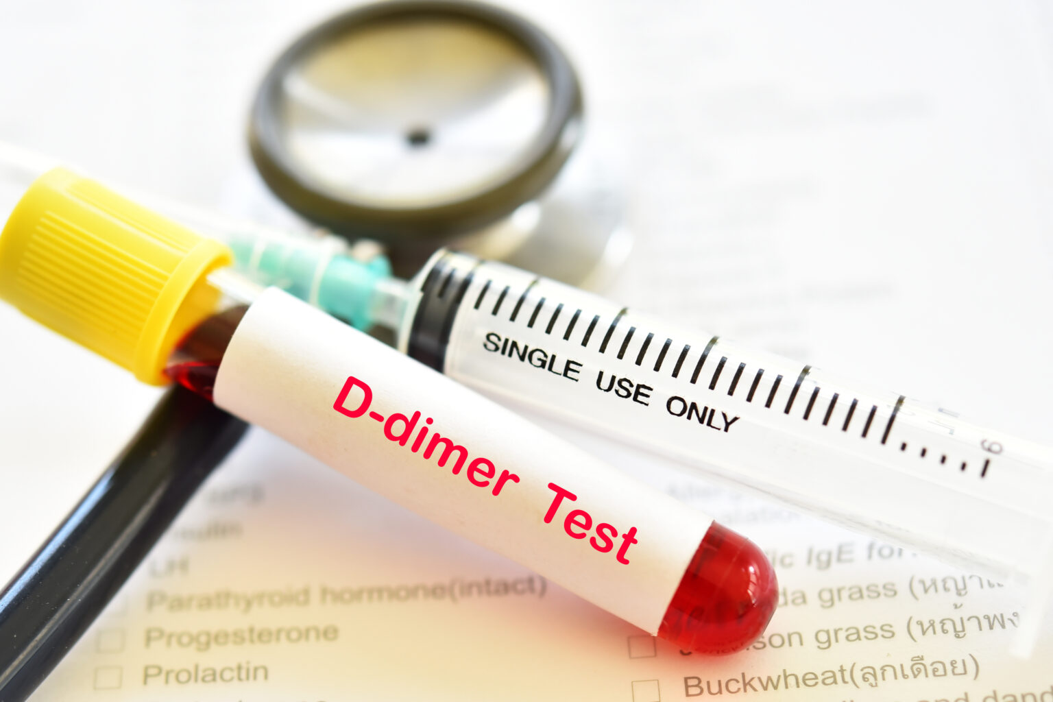 Blood,Sample,Tube,For,D-dimer,Test,,Diagnosis,For,Intravascular,Thrombosis Blood,Sample,Tube,For,D-dimer,Test,,Diagnosis,For,Intravascular,Thrombosis