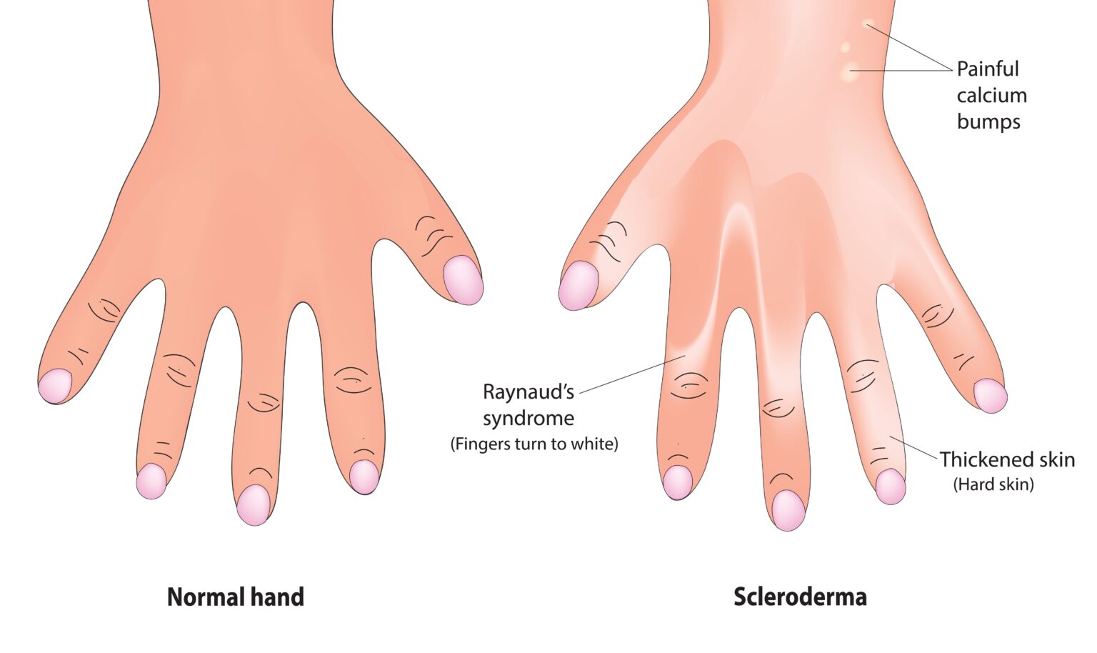Biological,Illustration,Of,Scleroderma,On,Hand