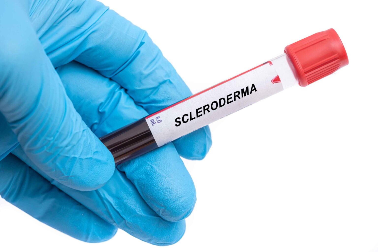 Scleroderma.,Scleroderma,Disease,Blood,Test,In,Doctor,Hand Scleroderma.,Scleroderma,Disease,Blood,Test,In,Doctor,Hand