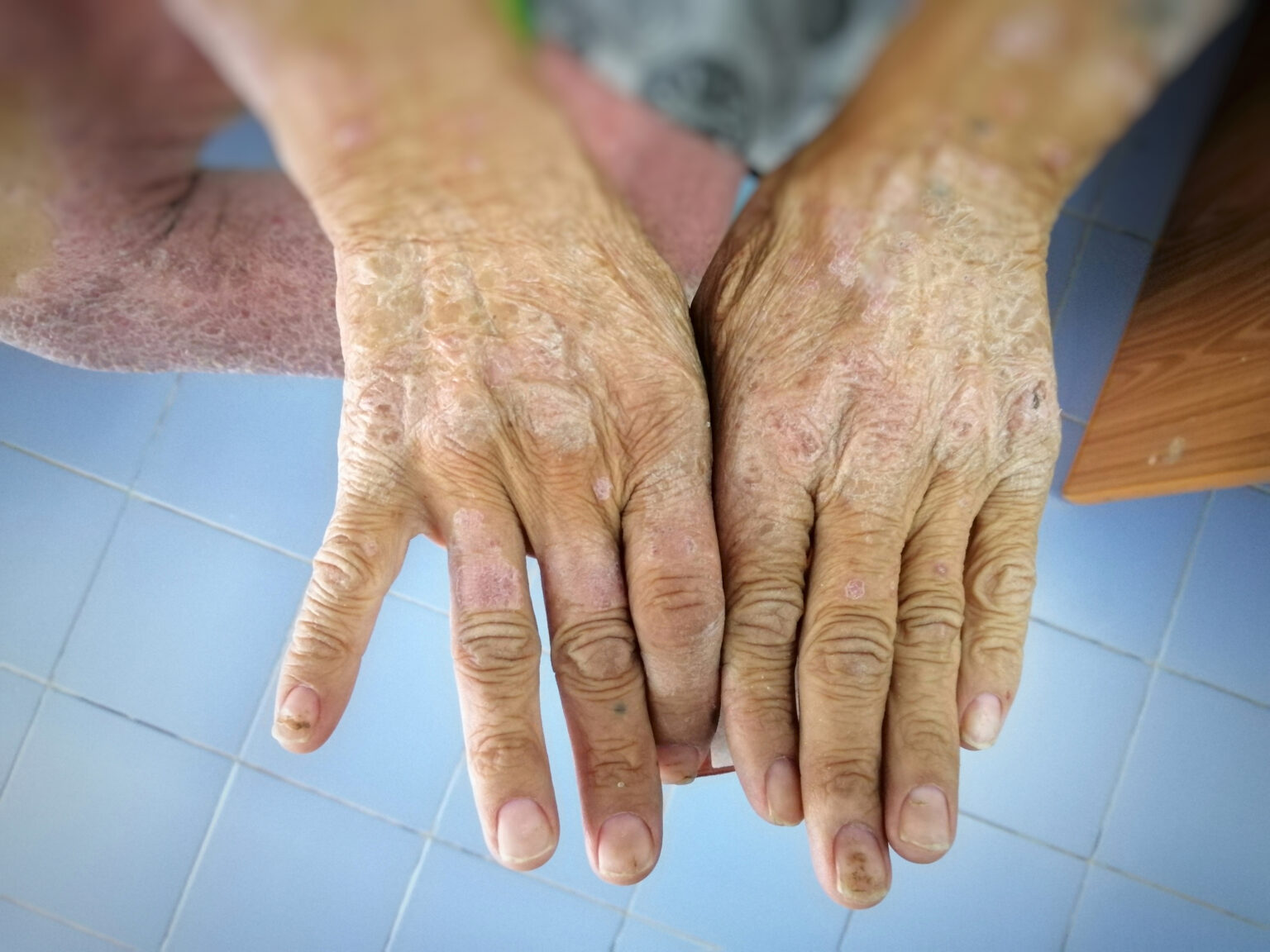 Skin,Disorder,,Pepper,Appearance,From,Scleroderma,,Autoimmune,Disease,Male,Hand Skin,Disorder,,Pepper,Appearance,From,Scleroderma,,Autoimmune,Disease,Male,Hand