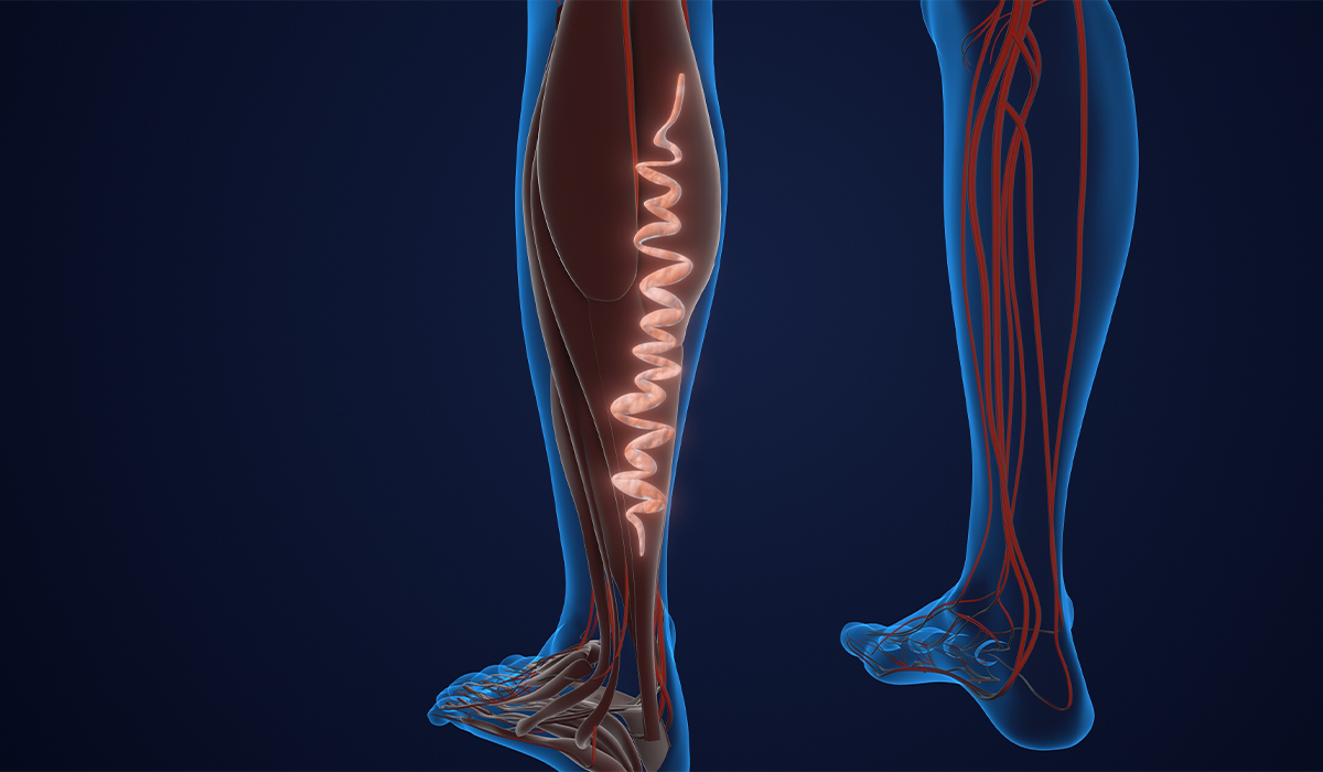 Varicose Veins