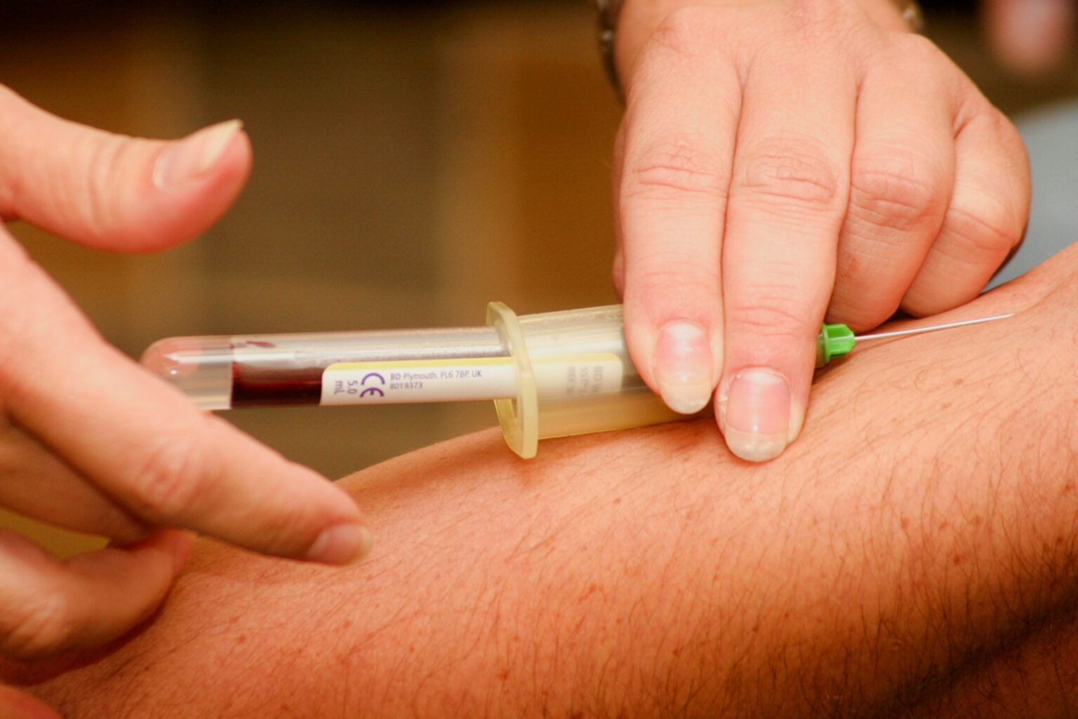 arm-pain-what-is-diagnosis-treatment-and-prognosis-157806 arm-pain-what-is-diagnosis-treatment-and-prognosis-157806