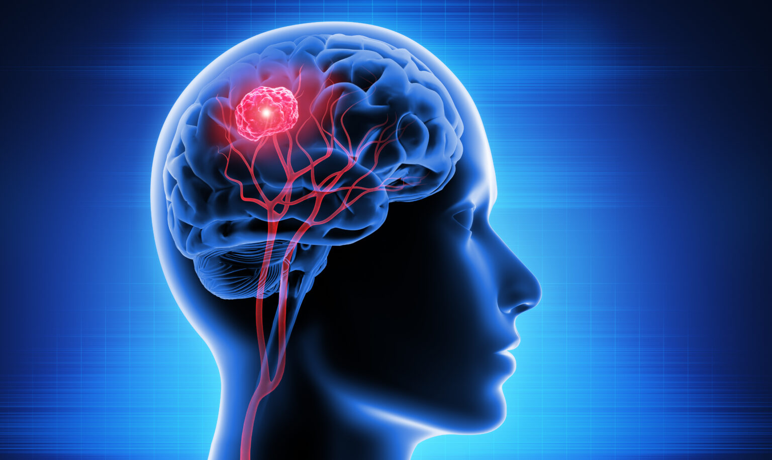 Head,With,Brain,And,Tumor,-,3d,Illustration
