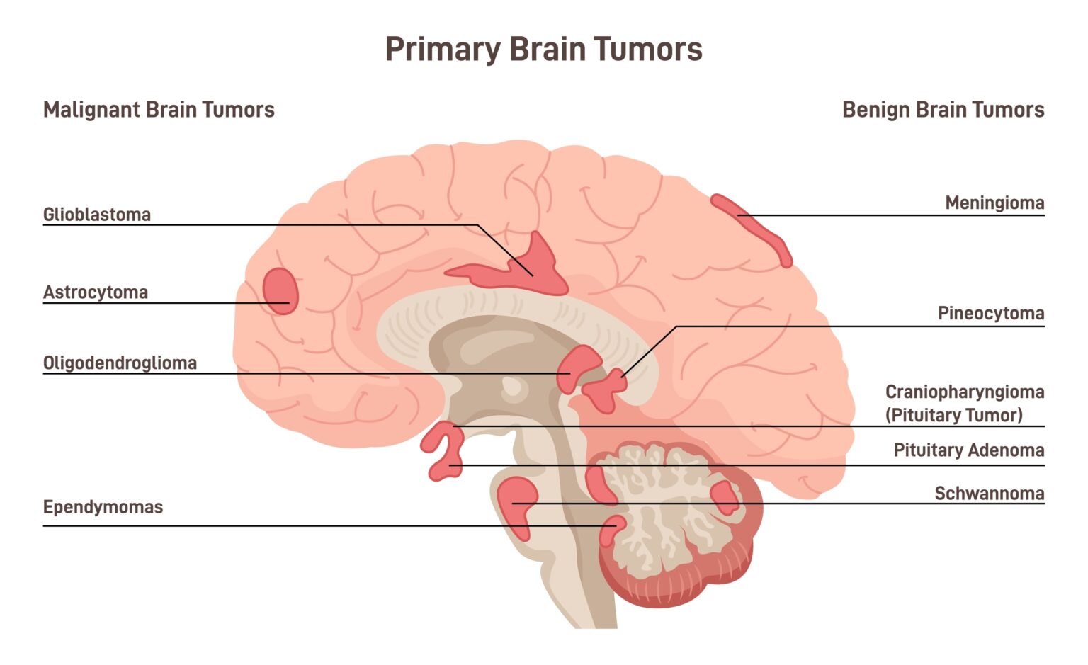 Brain,Cancer,Concept.,Primary,Brain,Tumors,Types.,Malignant,Cells,Develop Brain,Cancer,Concept.,Primary,Brain,Tumors,Types.,Malignant,Cells,Develop
