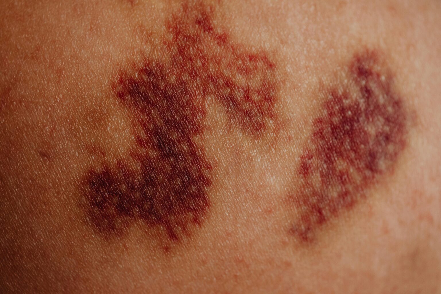 bruise-what-is-causes-when-to-see-a-doctor-509025 bruise-what-is-causes-when-to-see-a-doctor-509025