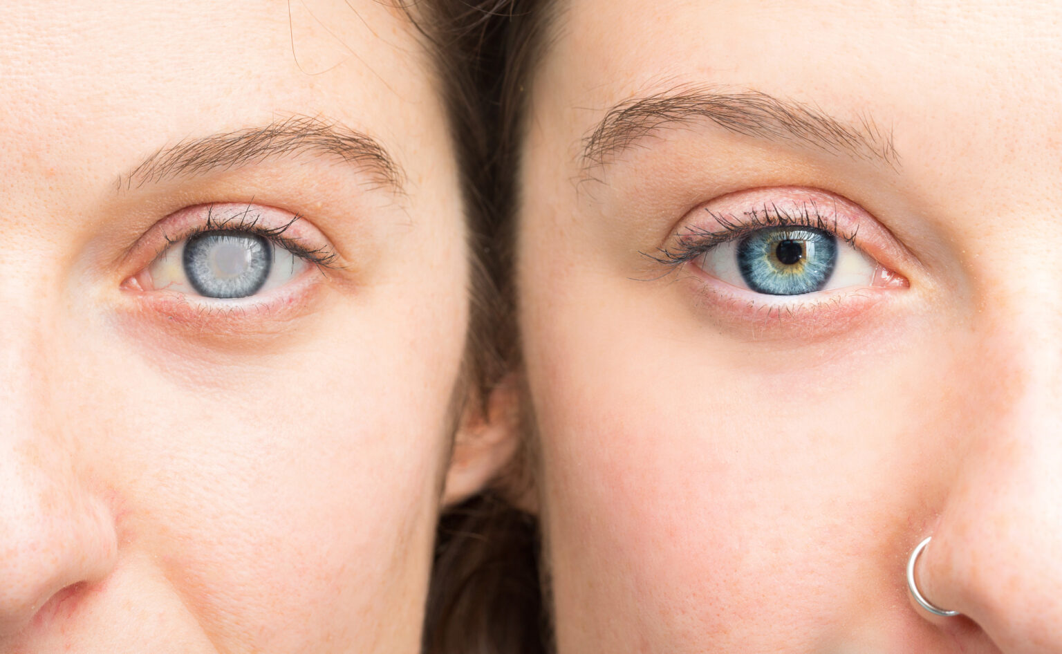 Woman,Showing,Eyes,Before,And,After,Cataract,Removal,And,Corneal Woman,Showing,Eyes,Before,And,After,Cataract,Removal,And,Corneal