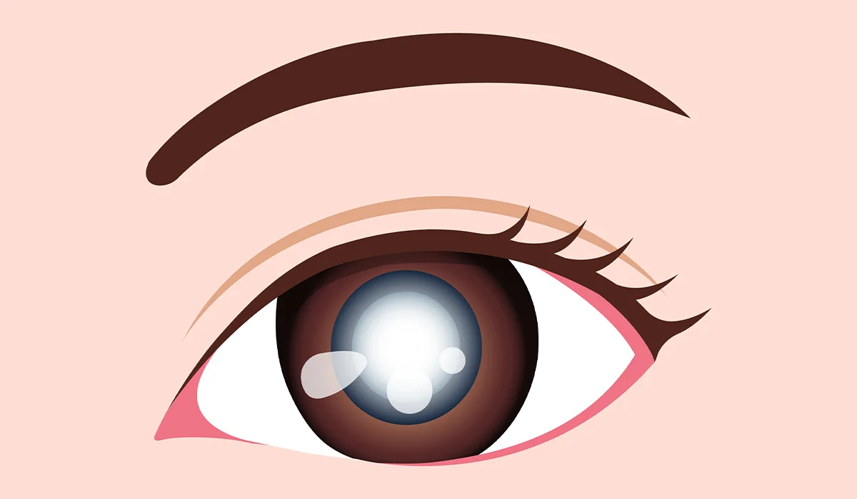 Cataract