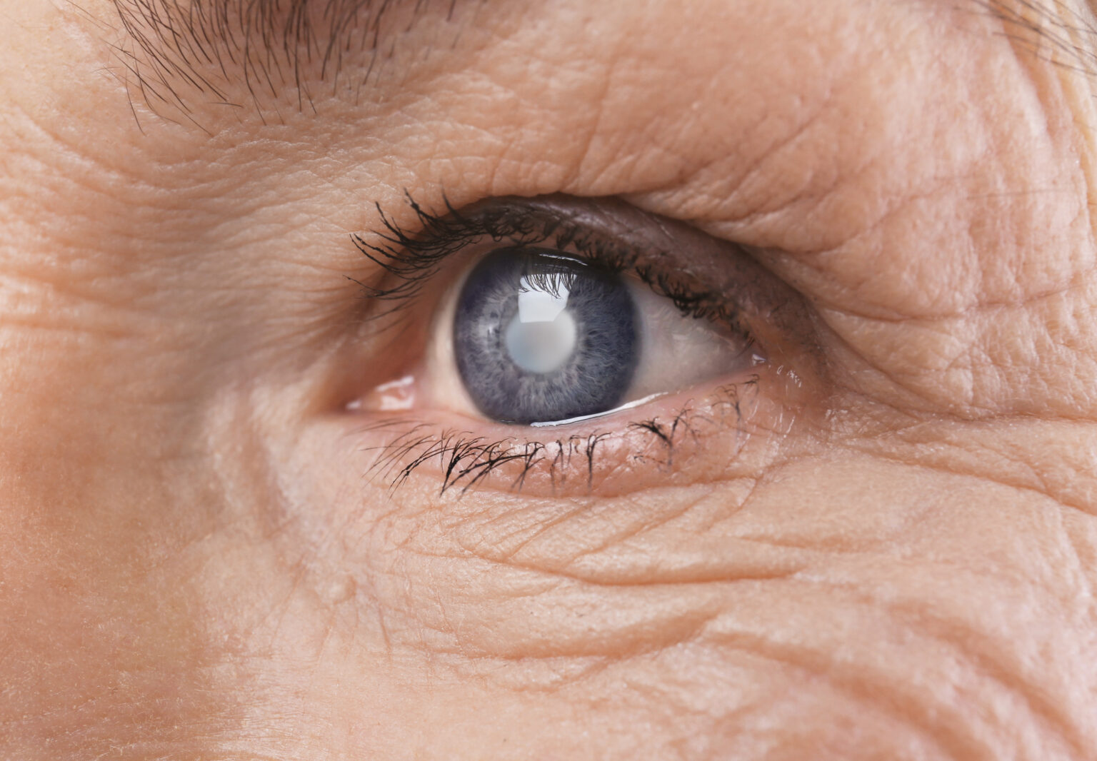 Cataract,Concept.,Senior,Woman’s,Eye,,Closeup Cataract,Concept.,Senior,Woman’s,Eye,,Closeup