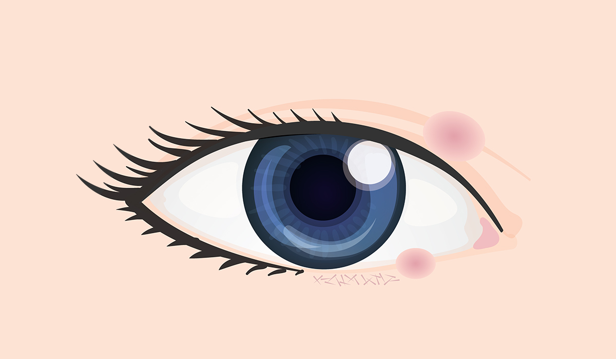 Chalazion