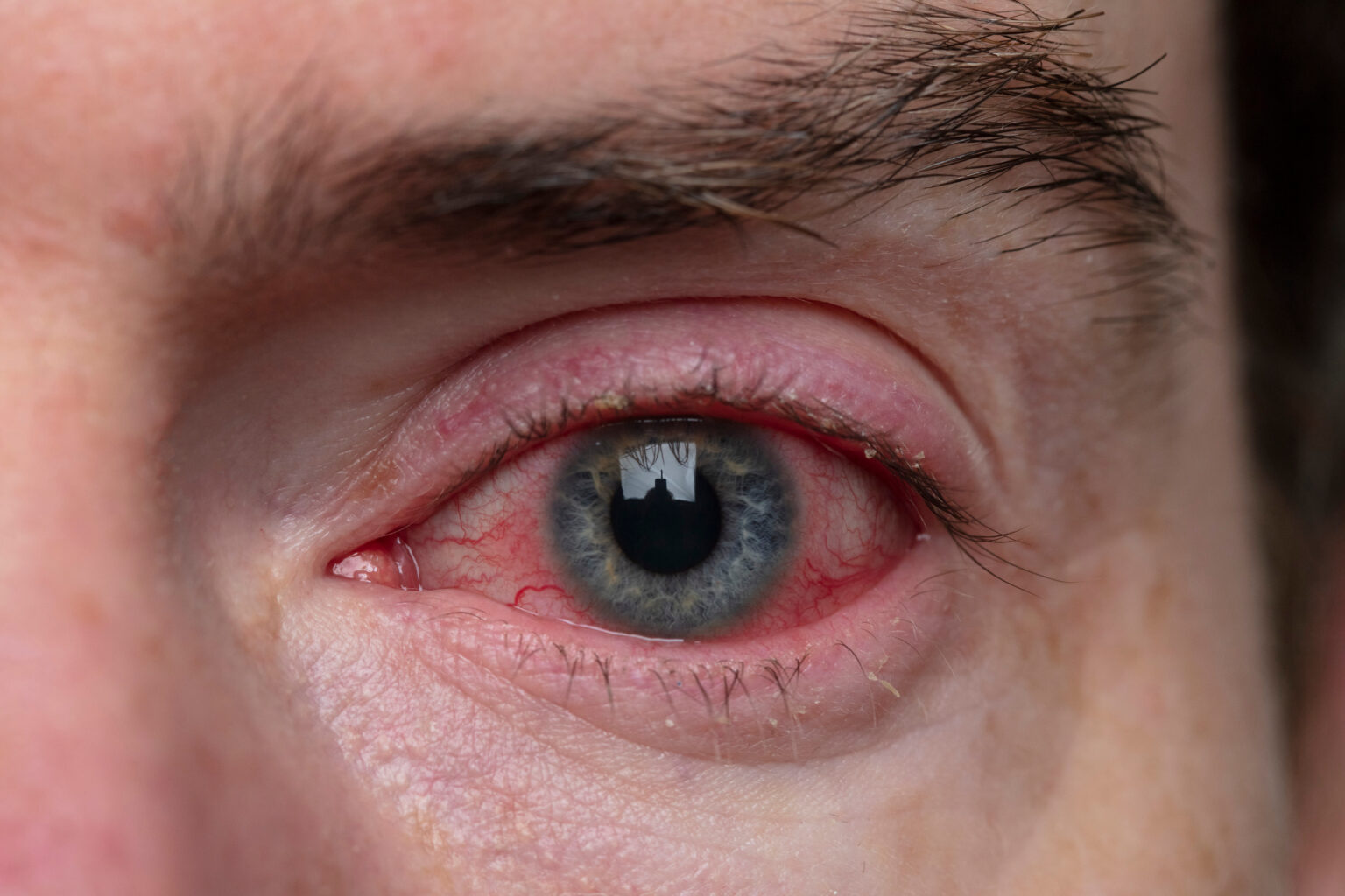 Close,Up,Of,A,Severe,Bloodshot,Eye.,Blepharitis,,Conjunctivitis,Condition Close,Up,Of,A,Severe,Bloodshot,Eye.,Blepharitis,,Conjunctivitis,Condition