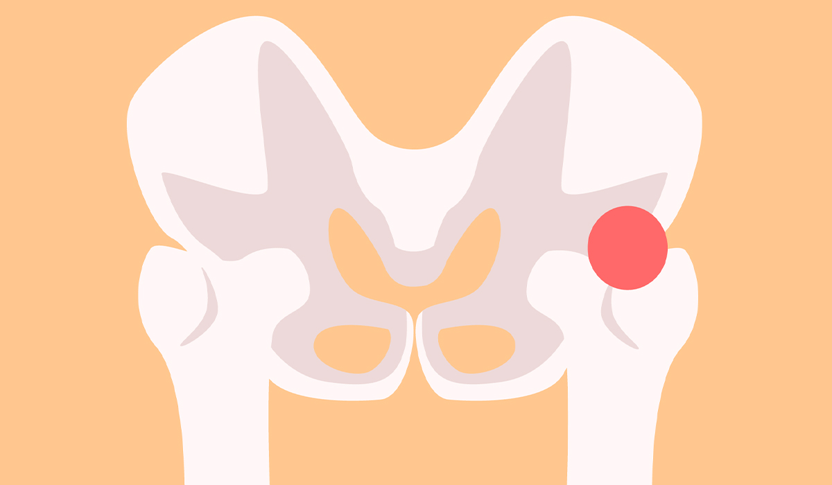 Hip Pain