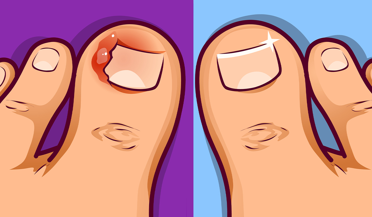 Ingrown Toenail