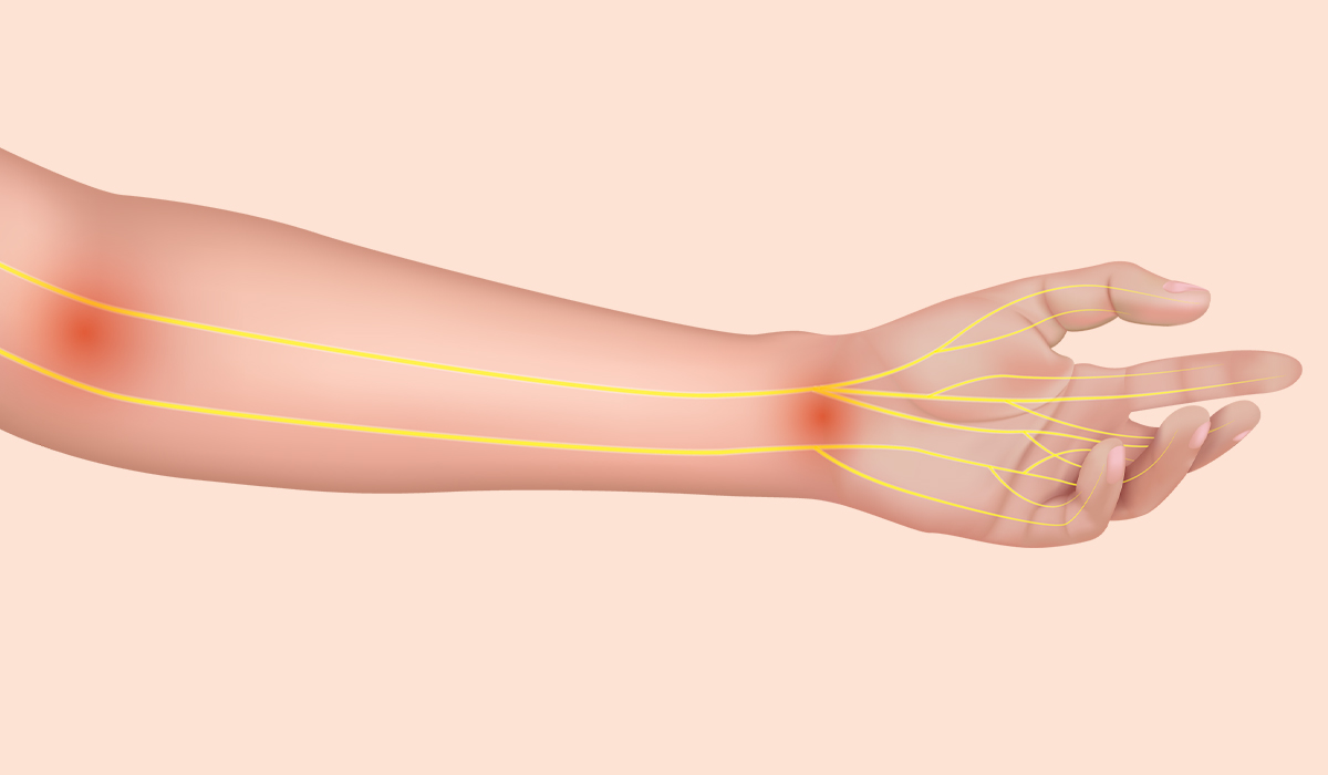 Nerve Pain