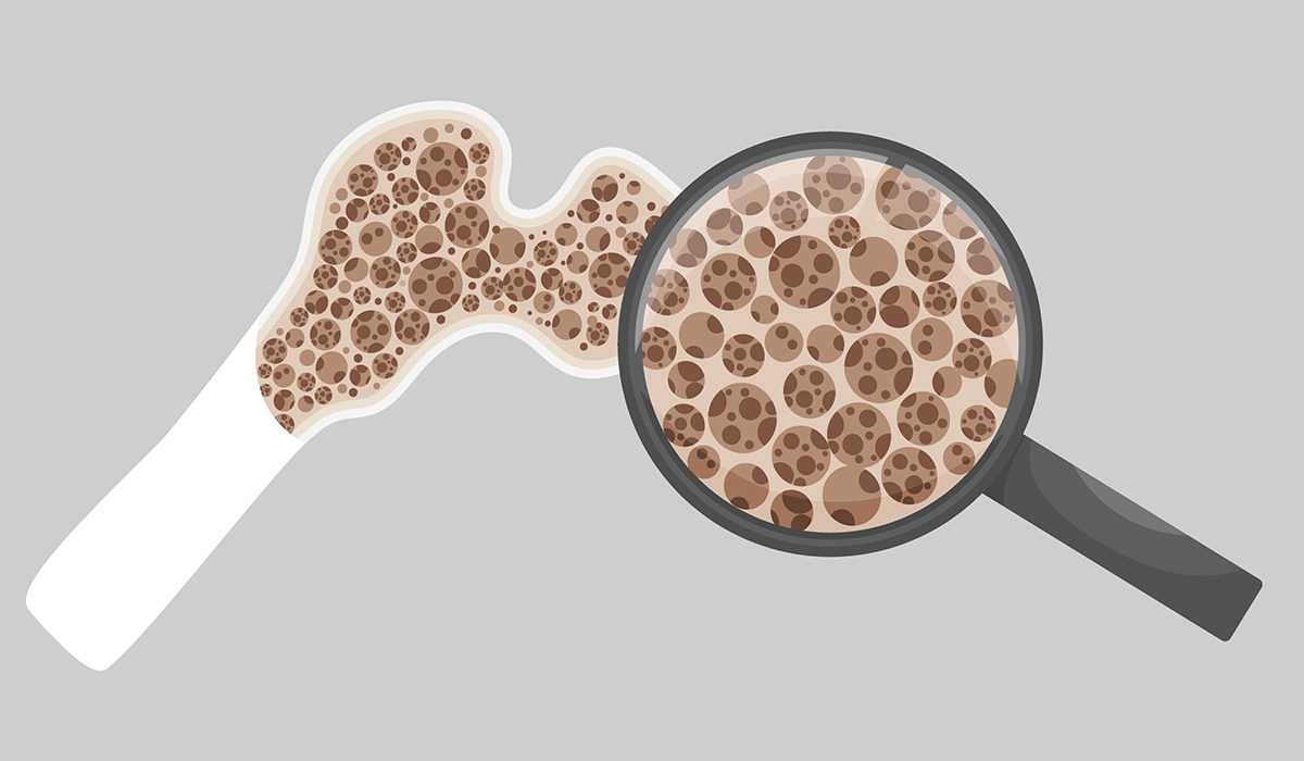 Osteoporosis