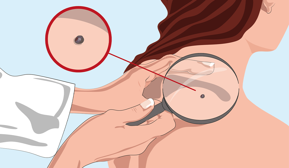 Skin Cancer