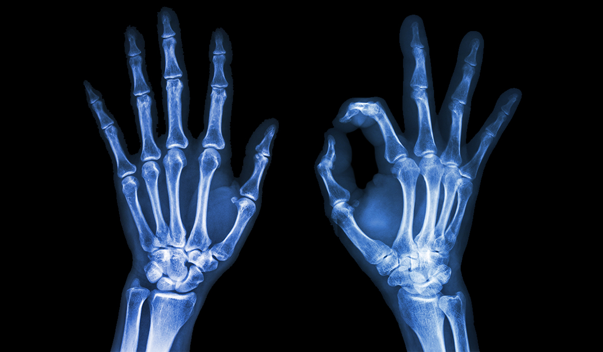 X-Ray: What Is, History, Uses, Procedure, Contrasting and Risk
