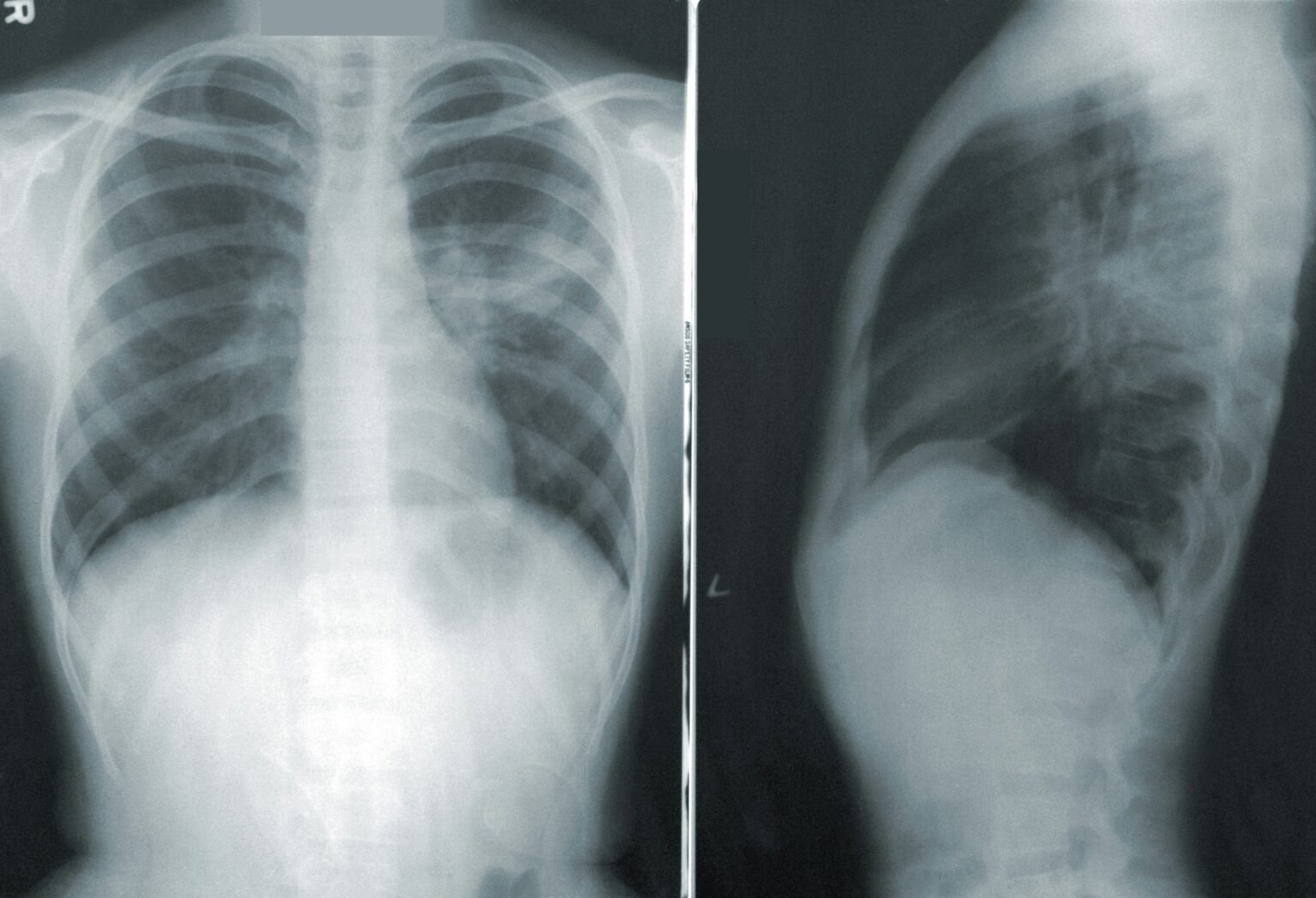 x-ray-what-is-history-uses-procedure-contrasting-and-risk-336484 x-ray-what-is-history-uses-procedure-contrasting-and-risk-336484