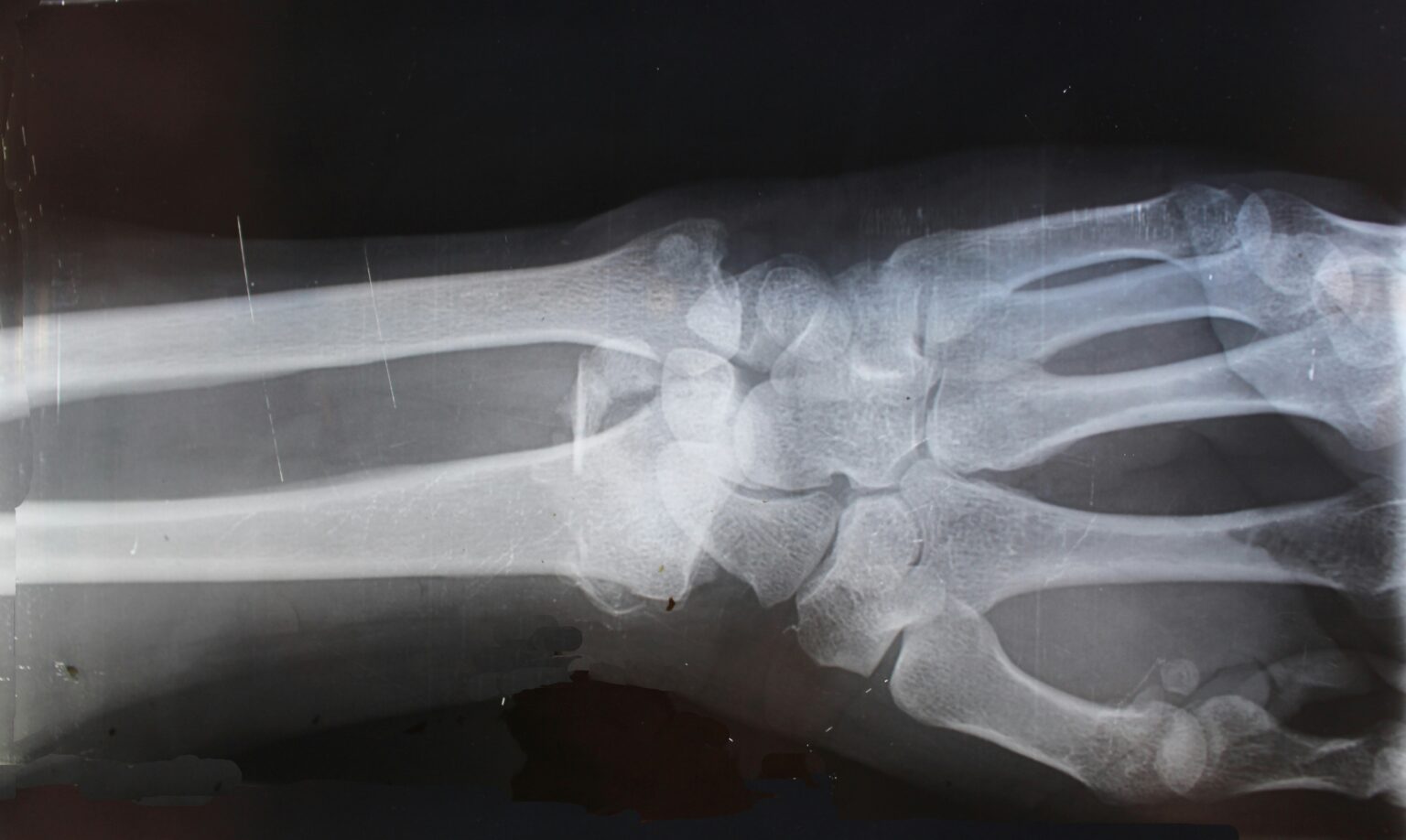x-ray-what-is-history-uses-procedure-contrasting-and-risk-785710 x-ray-what-is-history-uses-procedure-contrasting-and-risk-785710
