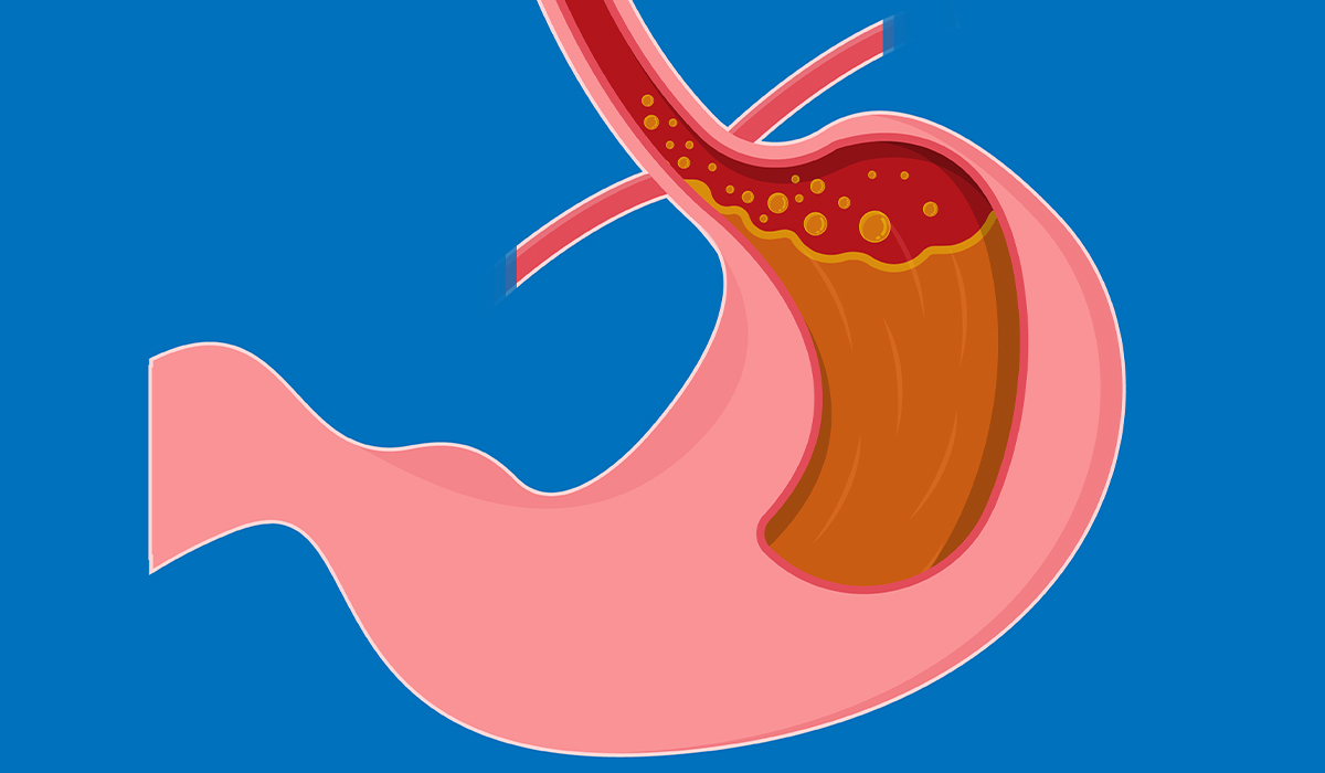 Zollinger-Ellison Syndrome: What Is, Cause, Symptoms, and Diagnosis