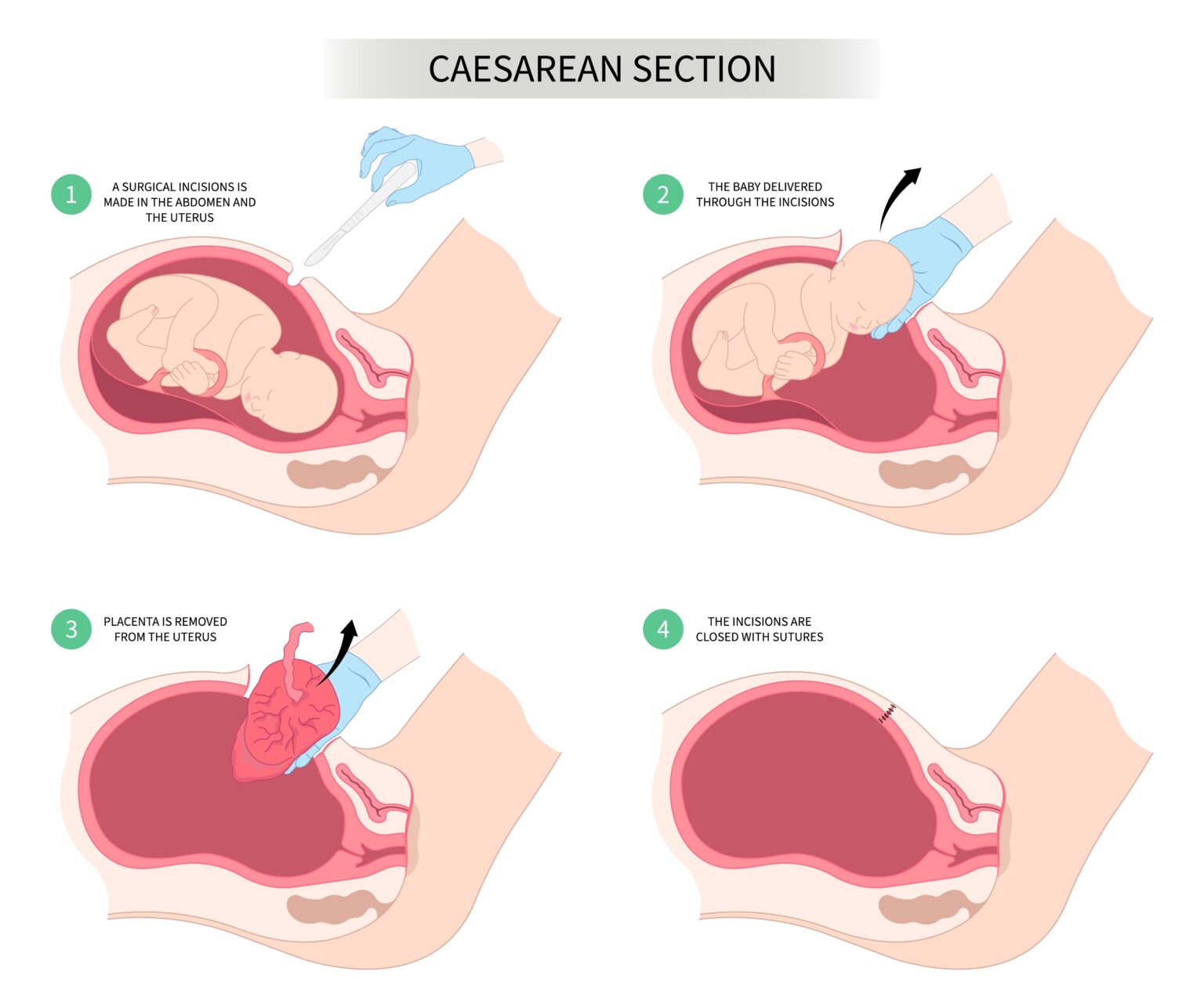 Newborn,Baby,Birth,Prolapse,Umbilical,Cord,Twins,Pregnancy,Scar,Womb