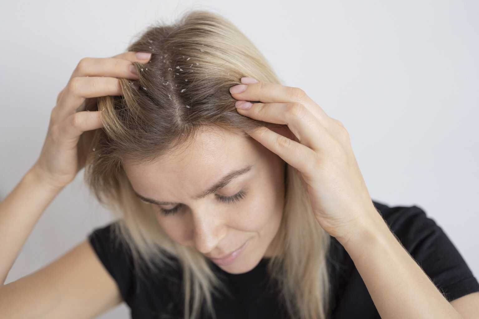 dry-scalp-what-is-symptoms-causes-treatment-261741 dry-scalp-what-is-symptoms-causes-treatment-261741
