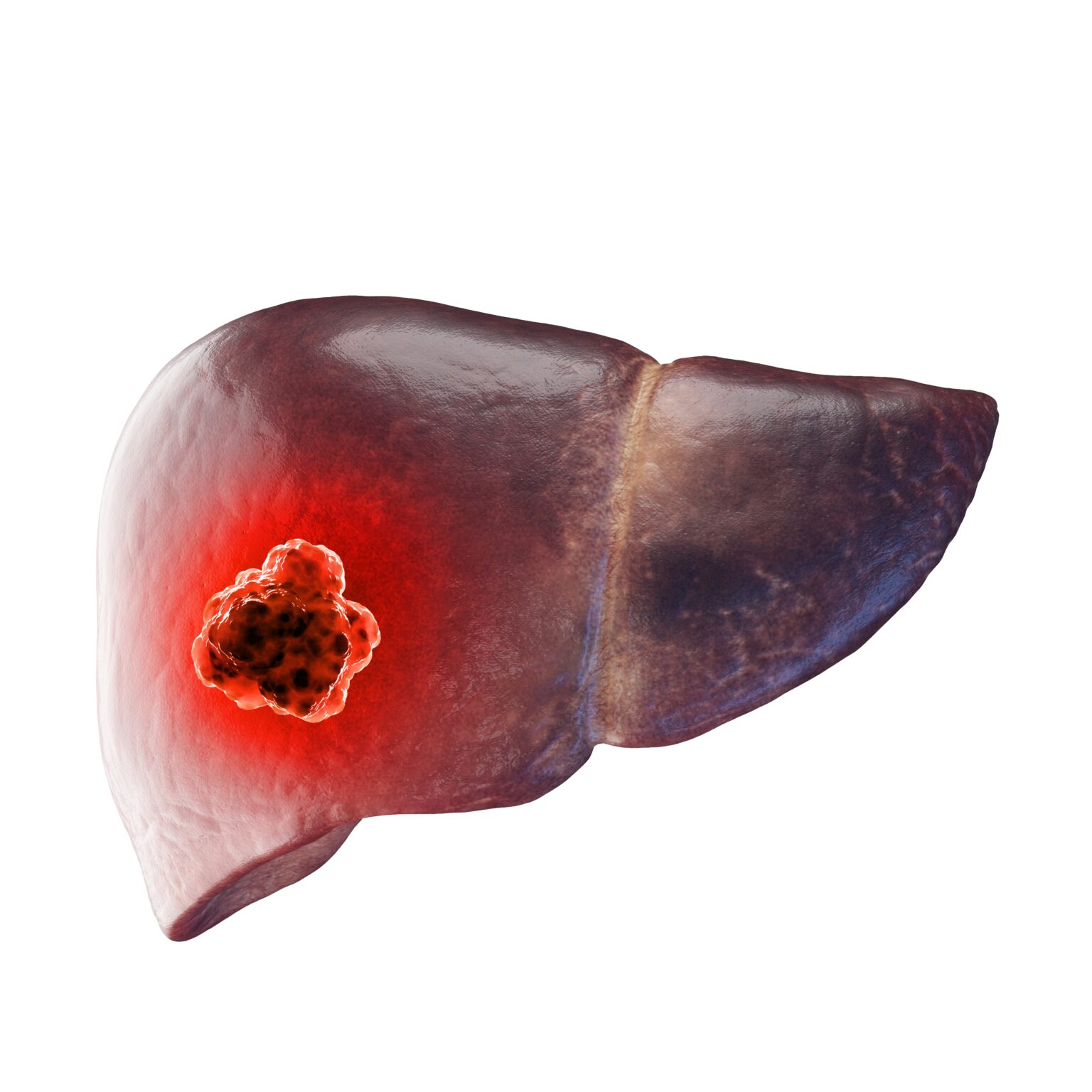 3d,Rendered,Medical,Illustration,Of,Liver,Cancer.,Plain,White,Background.