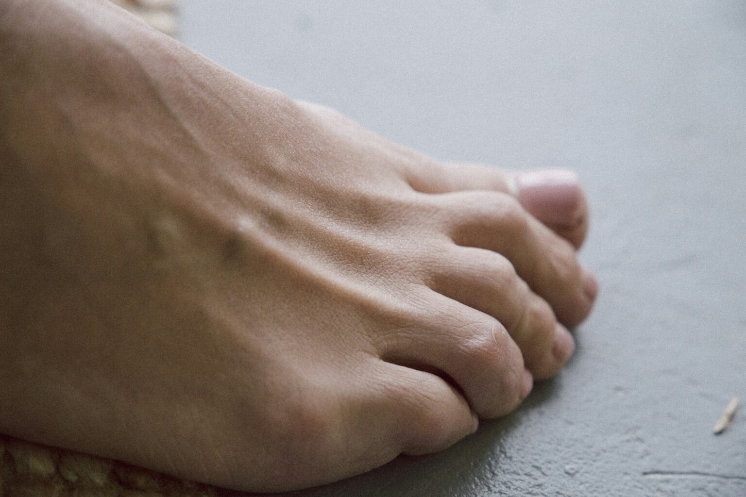 toenail-fungus-what-is-causes-treatment-and-prevention-585884