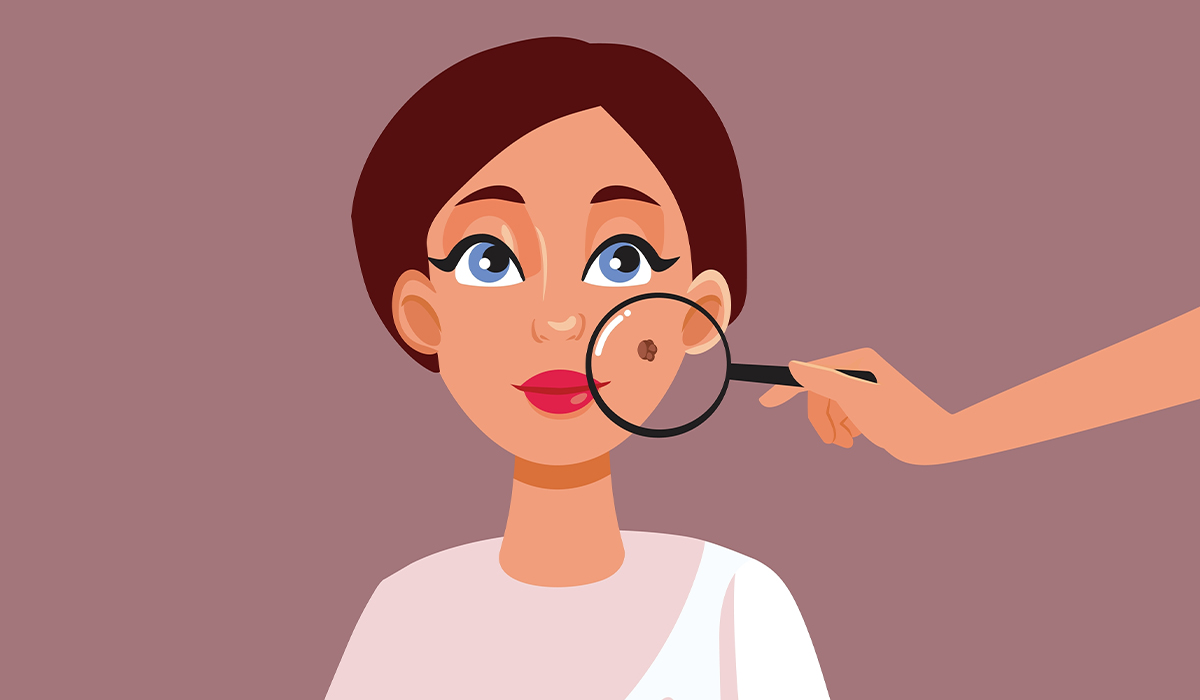 Moles: What Are, Causes, Types, Diagnosis, and Treatment